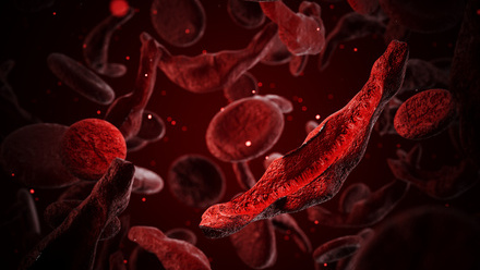 Sickle cell