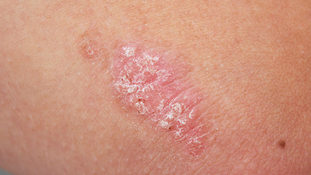 Psoriasis skin.jpg