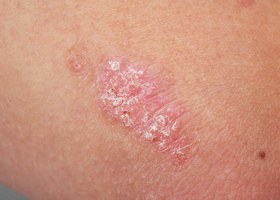 Psoriasis skin.jpg