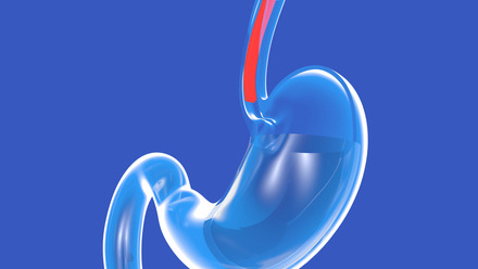 Acid reflux.jpg