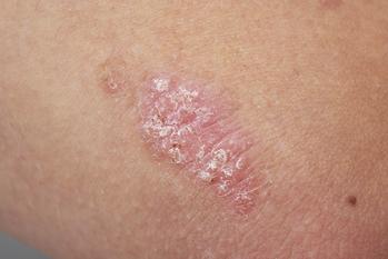 Psoriasis is a common chronic inflammatory skin condition that can have an enormous impact on quality of life